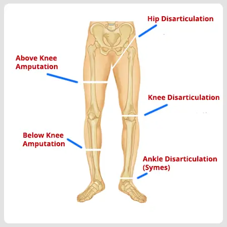 lowerlimb-amputation-1