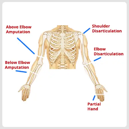 upperlimb-amputation-1